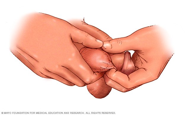 Testicular exam - Drugs.com epidermoid cyst diagram 